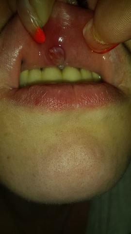 piercing blase was tun oberlippe