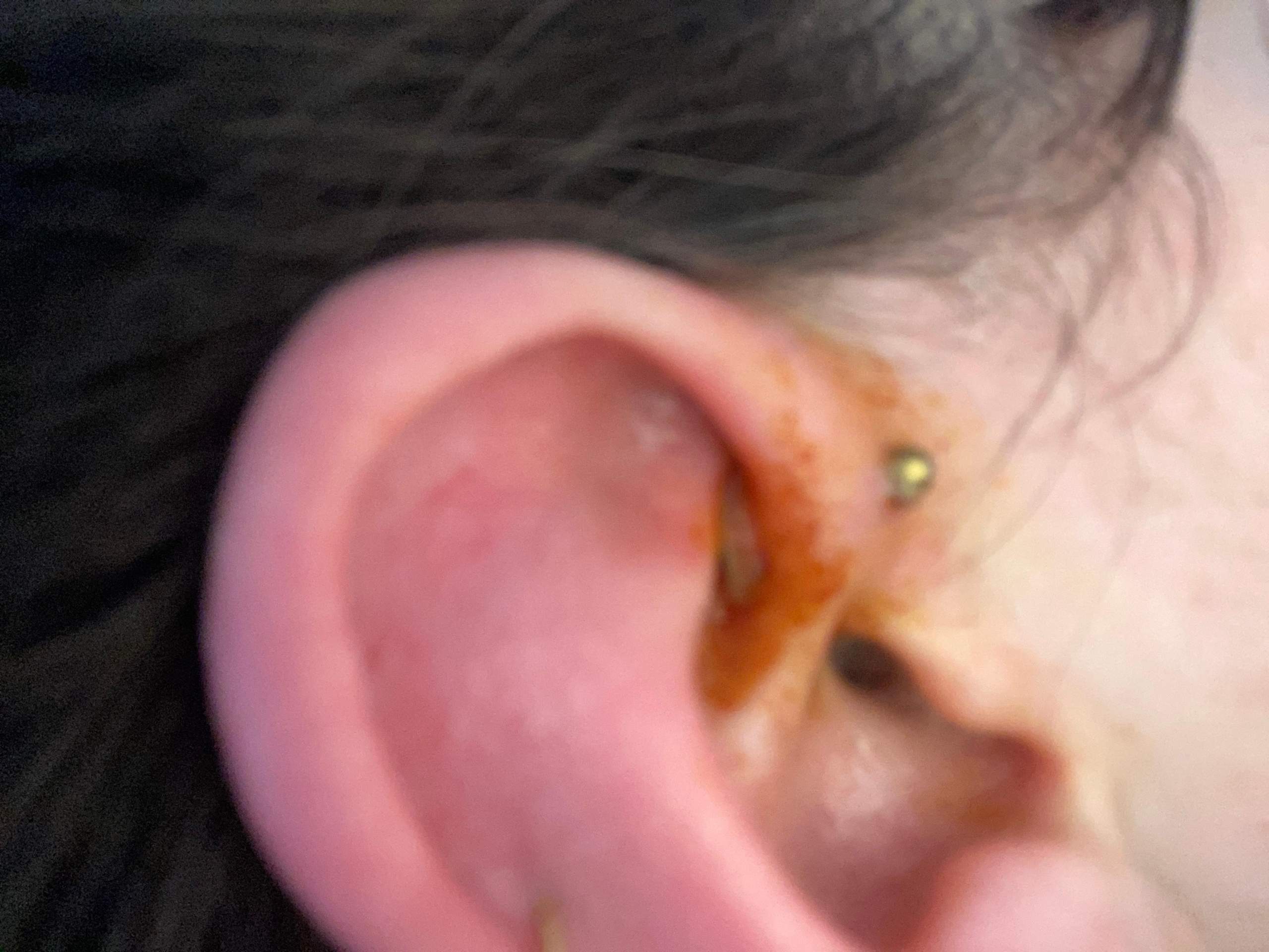 Piercing sehr entzündet? (Entzündung, Ohr, Helix)