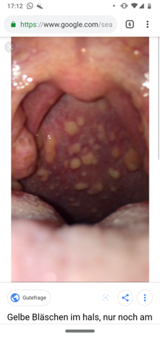 Pilz Im Rachen Gesundheit Und Medizin Gesundheit Arzt Pilz Im Rachen Gesundheit Und Medizin Gesundheit Arzt