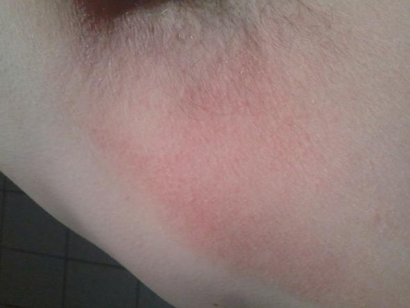 Starkes Schwitzen Unter Den Achseln Ursache Shefalitayal Starkes Schwitzen Unter Den Achseln Ursache Shefalitayal