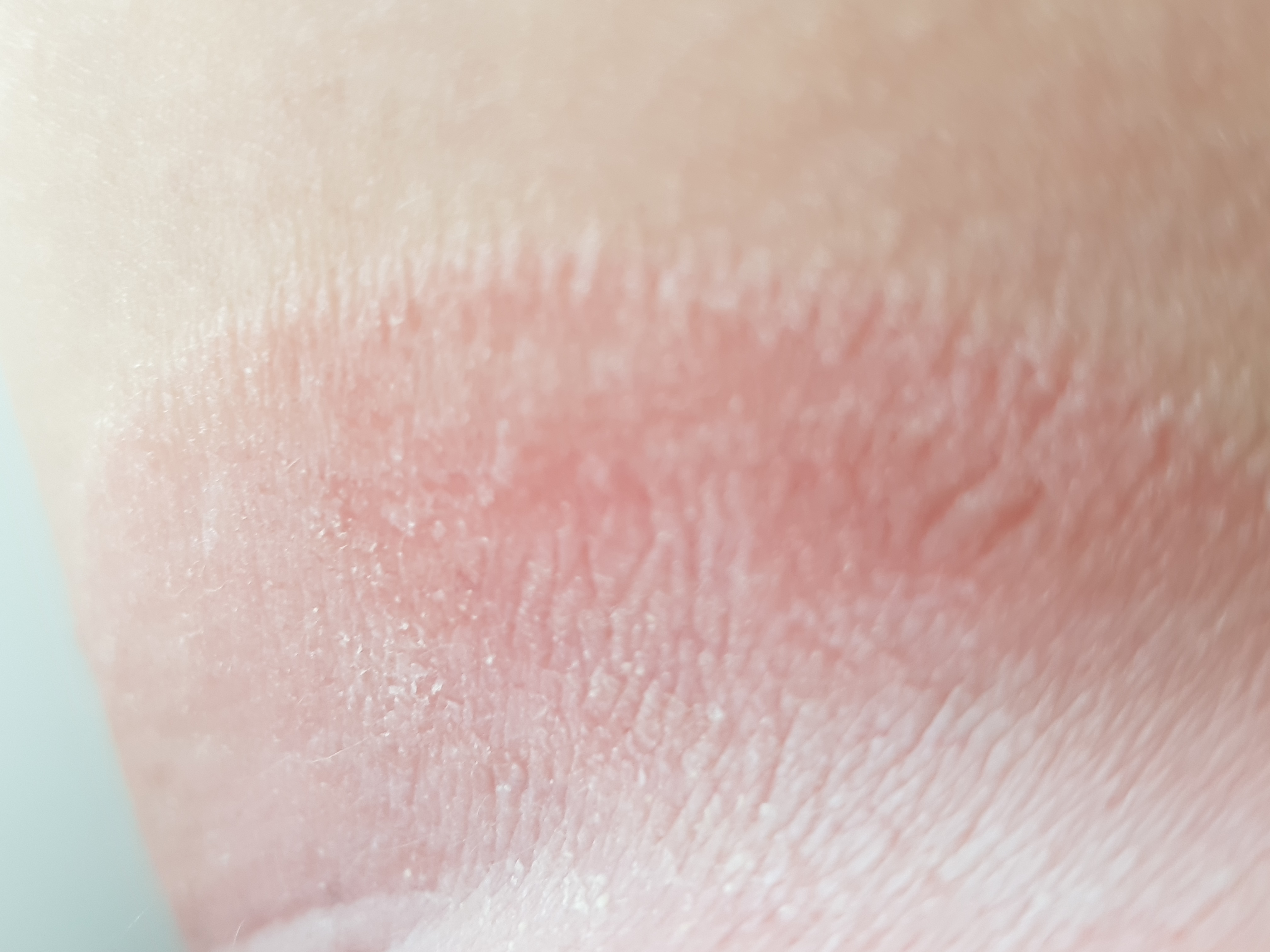 Pilz zwischen den Beinen? (Gesundheit und Medizin, Heilung, Pilze) Pilz zwischen den Beinen? (Gesundheit und Medizin, Heilung, Pilze)