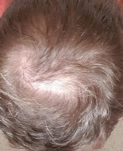 platte im anmarsch haare kopf