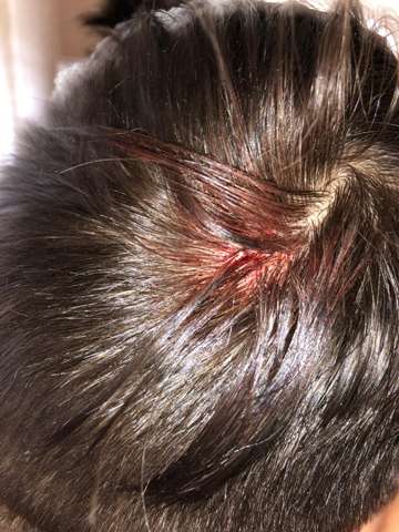 Platzwunde Am Hinterkop Was Tunf Gesundheit Und Medizin Verletzung Hinterkopf Platzwunde Am Hinterkop Was Tunf Gesundheit Und Medizin Verletzung Hinterkopf