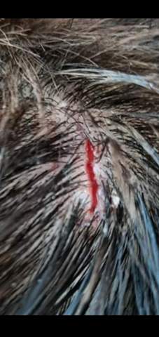 Platzwunde Am Kopf Nahen Wunde Kopfhaut Platzwunde Am Kopf Nahen Wunde Kopfhaut
