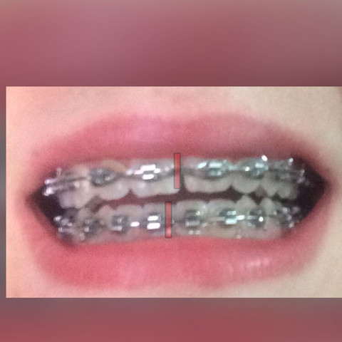 Meine Zahnspange und der Kreuzbiss - (Zähne, Zahnarzt, Zahnspange)