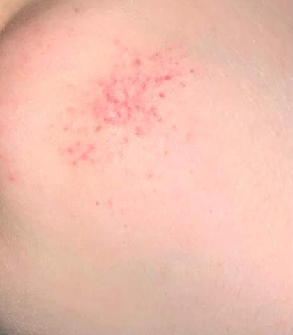 Plotzlich Aus Dem Nichts Kleine Rote Punkte Auf Der Haut Im Halsbereich Gesundheit Und Medizin Gesundheit Medizin Plotzlich Aus Dem Nichts Kleine Rote Punkte Auf Der Haut Im Halsbereich Gesundheit Und Medizin Gesundheit Medizin