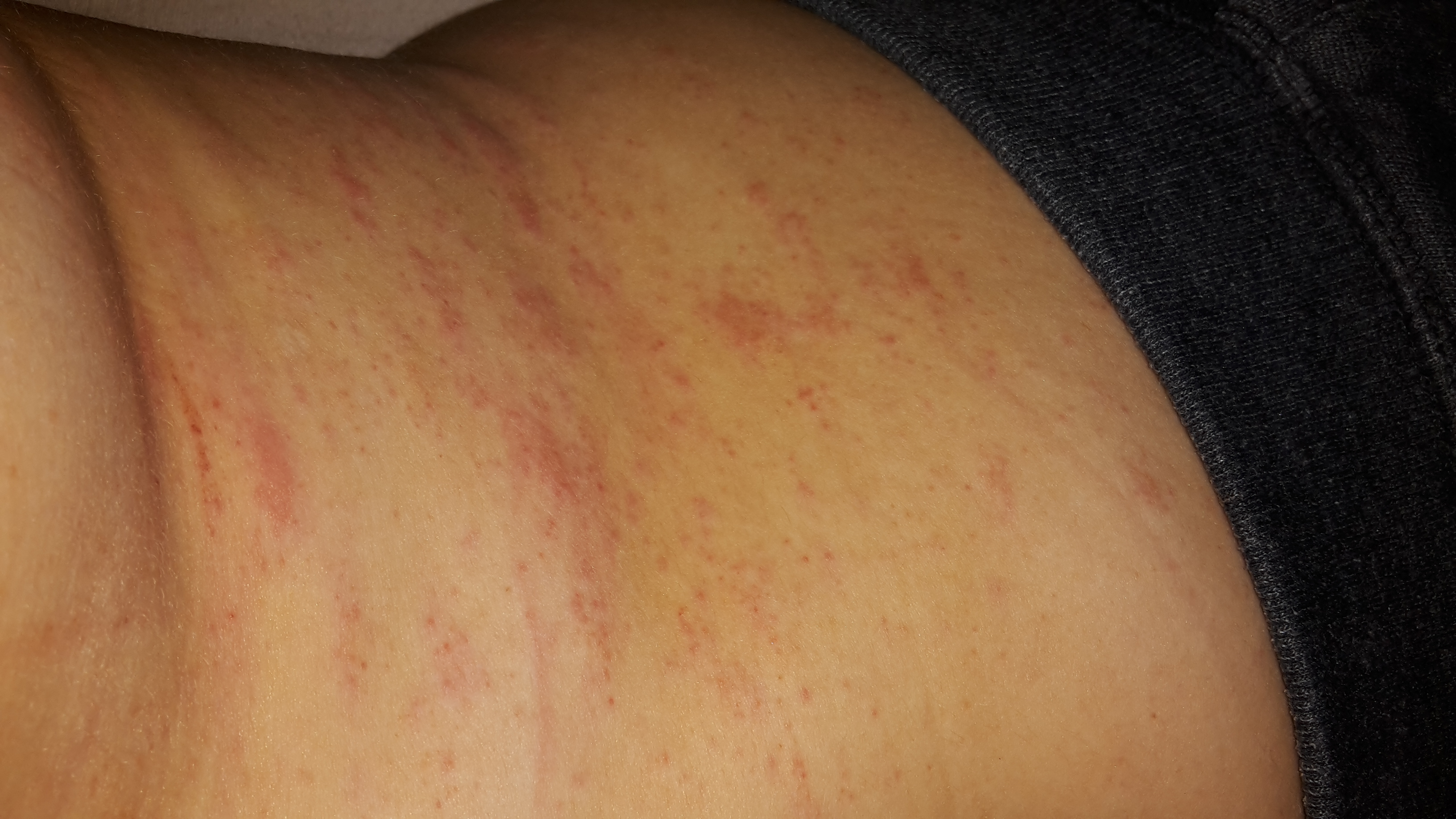 Plötzlich Ausschlag am Bauch (Gesundheit, Medizin, Arzt) Plötzlich Ausschlag am Bauch (Gesundheit, Medizin, Arzt)