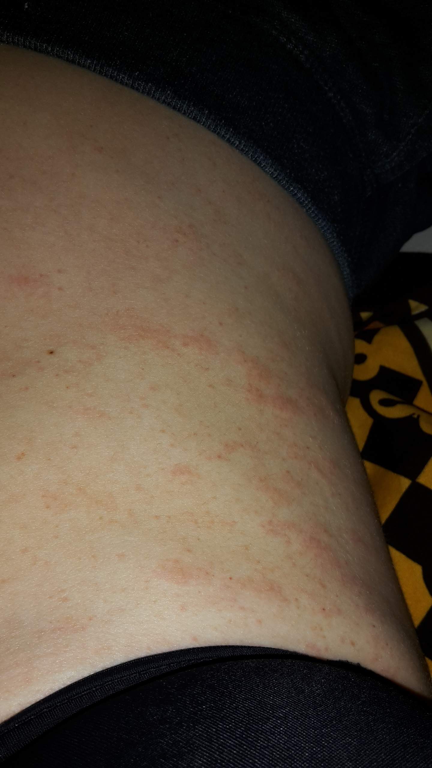 Plötzlich Ausschlag am Bauch (Gesundheit, Medizin, Arzt)