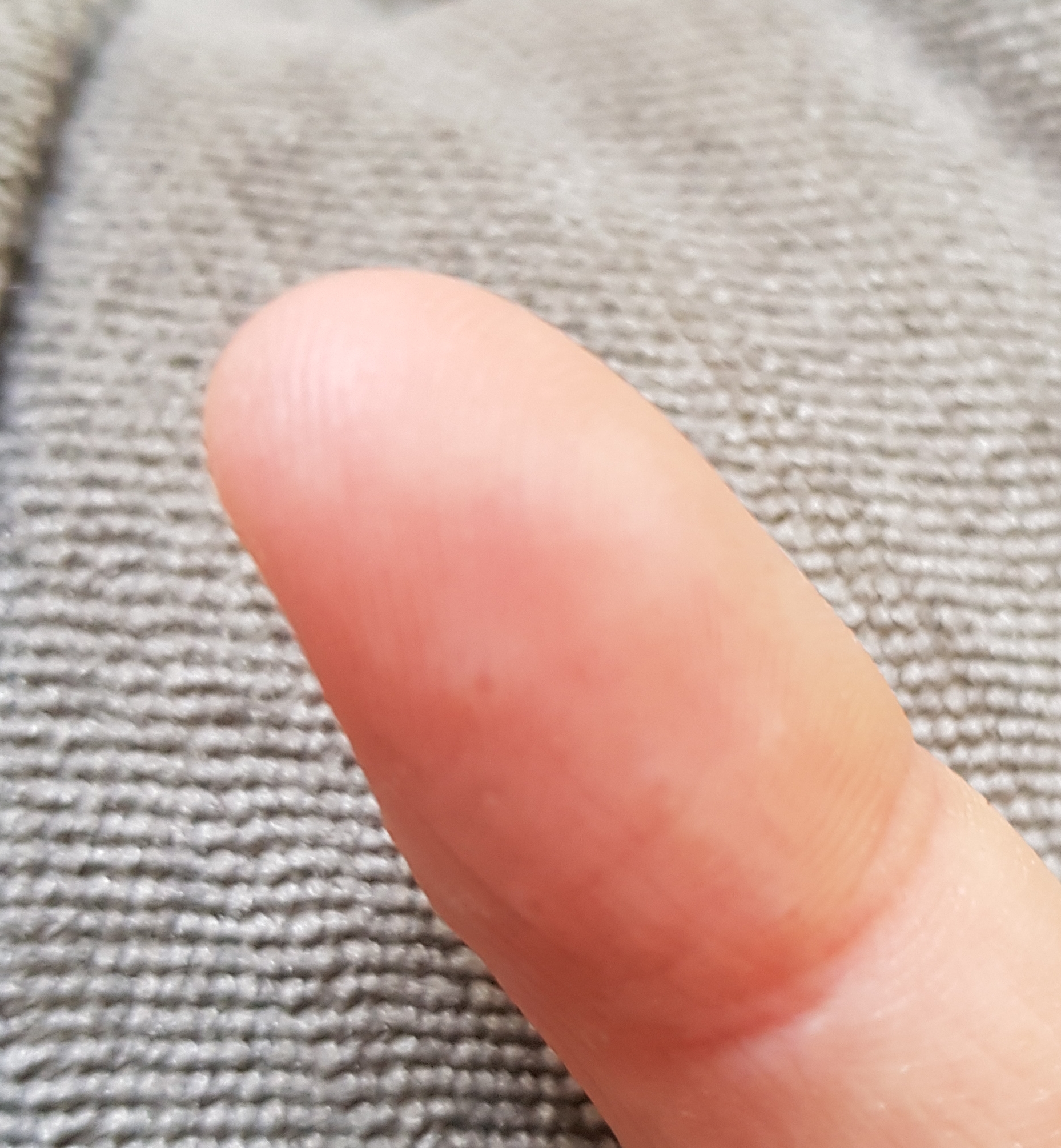 Plötzlich Bläschen am Finger? (Gesundheit und Medizin, Gesundheit, Medizin) Plötzlich Bläschen am Finger? (Gesundheit und Medizin, Gesundheit, Medizin)