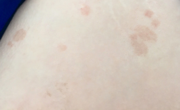 Flecken der violette haut auf Hautblutung