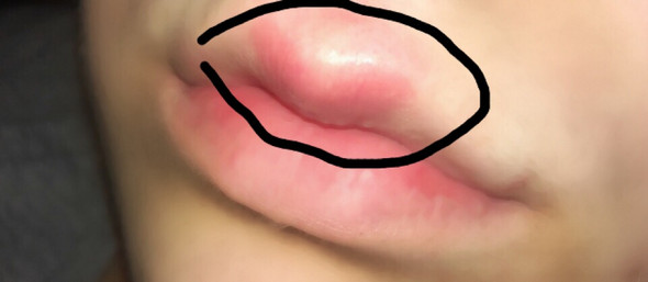 Lippen geschwollene 