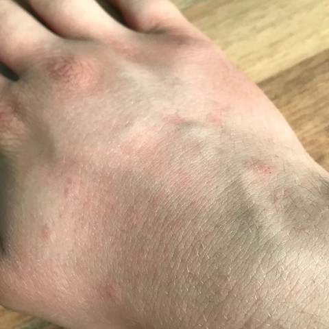 Meine Hand mit dem leichten Ausschlag - (Gesundheit und Medizin, Haut, Juckreiz)