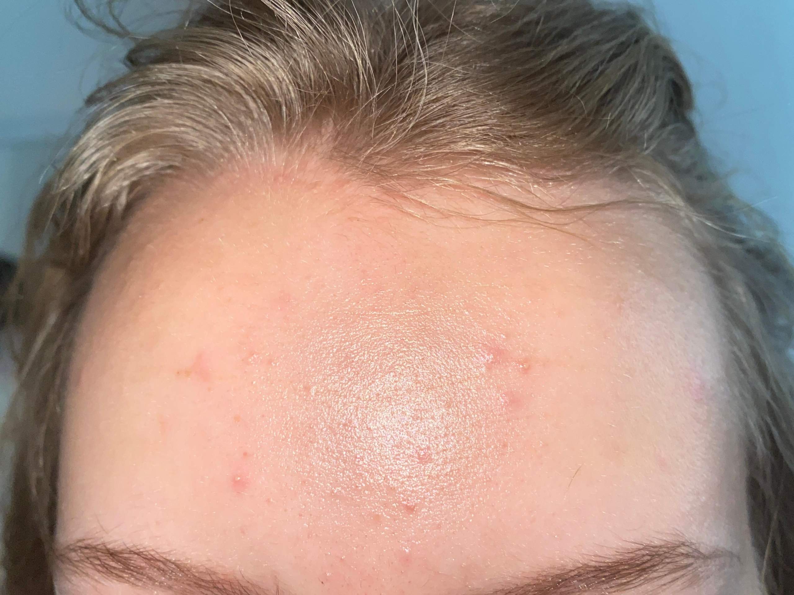 Plötzlich Pickel auf Stirn? (Gesundheit und Medizin, Haut) pickel auf stirn