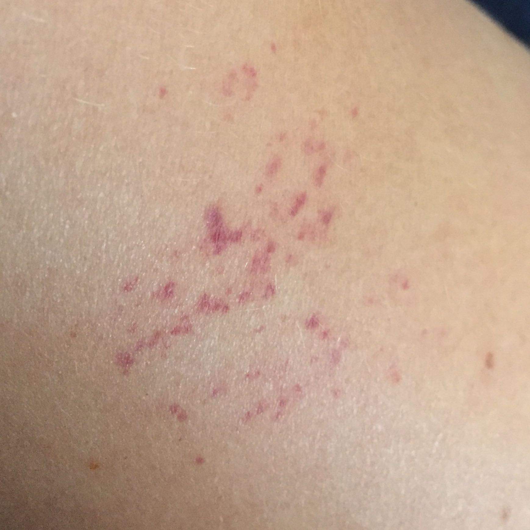 Rote Punkte überall auf der Haut, weiß jemand was das sein könnte?  (Erfahrungen, Hautarzt, Ausschlag)