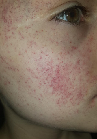 Plotzlich Rote Punkte Im Gesicht Nach Ubergeben Gesundheit Und Medizin Gesundheit Haut