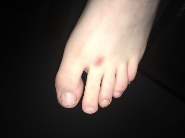 Plötzlich roter Fleck am Fuß was ist das? (Gesundheit und Medizin Plötzlich roter Fleck am Fuß was ist das? (Gesundheit und Medizin