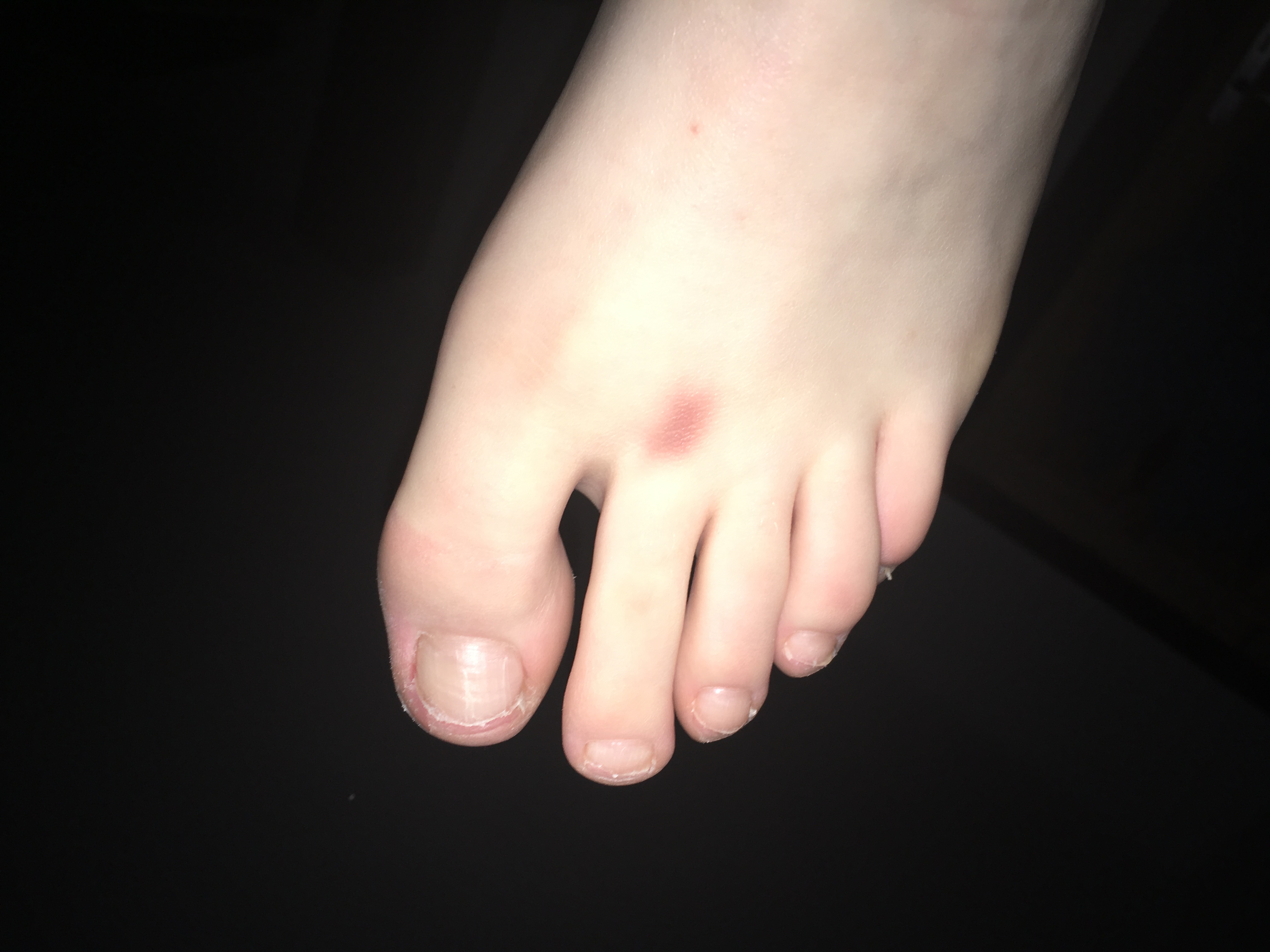 Plötzlich roter Fleck am Fuß was ist das? (Gesundheit und Medizin Plötzlich roter Fleck am Fuß was ist das? (Gesundheit und Medizin