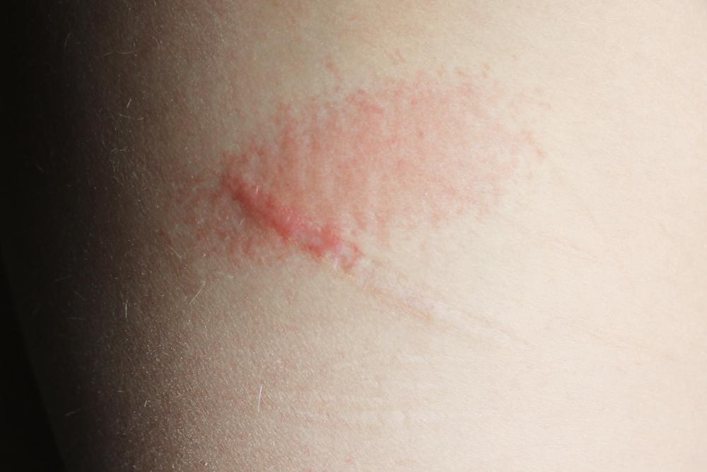 Plötzlich schmerzende, rote Flecken auf den Oberschenkeln! (Arzt, Haut, Hautpflege) Plötzlich schmerzende, rote Flecken auf den Oberschenkeln! (Arzt, Haut, Hautpflege)