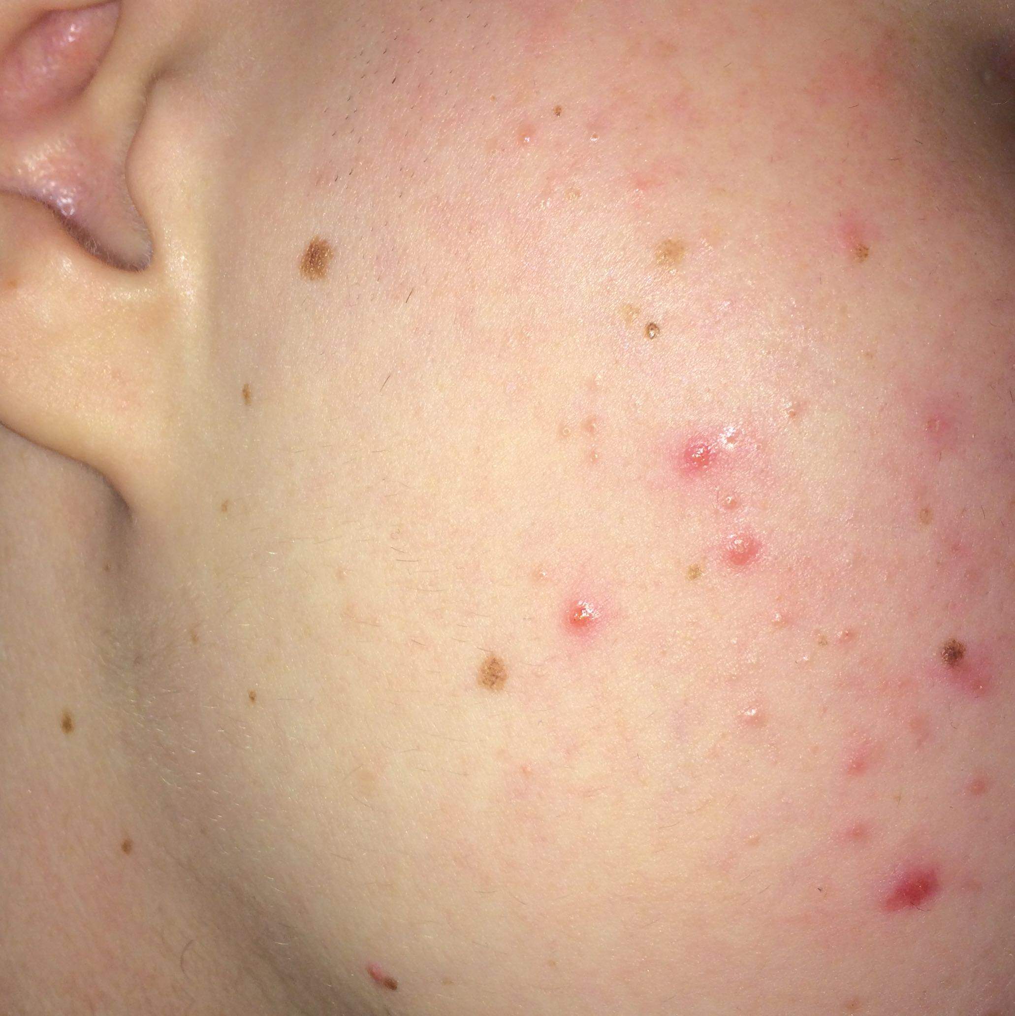 Plötzlich so viele Pickel, was tun? (Haut, Aussehen, Pflege) pickel einnistung