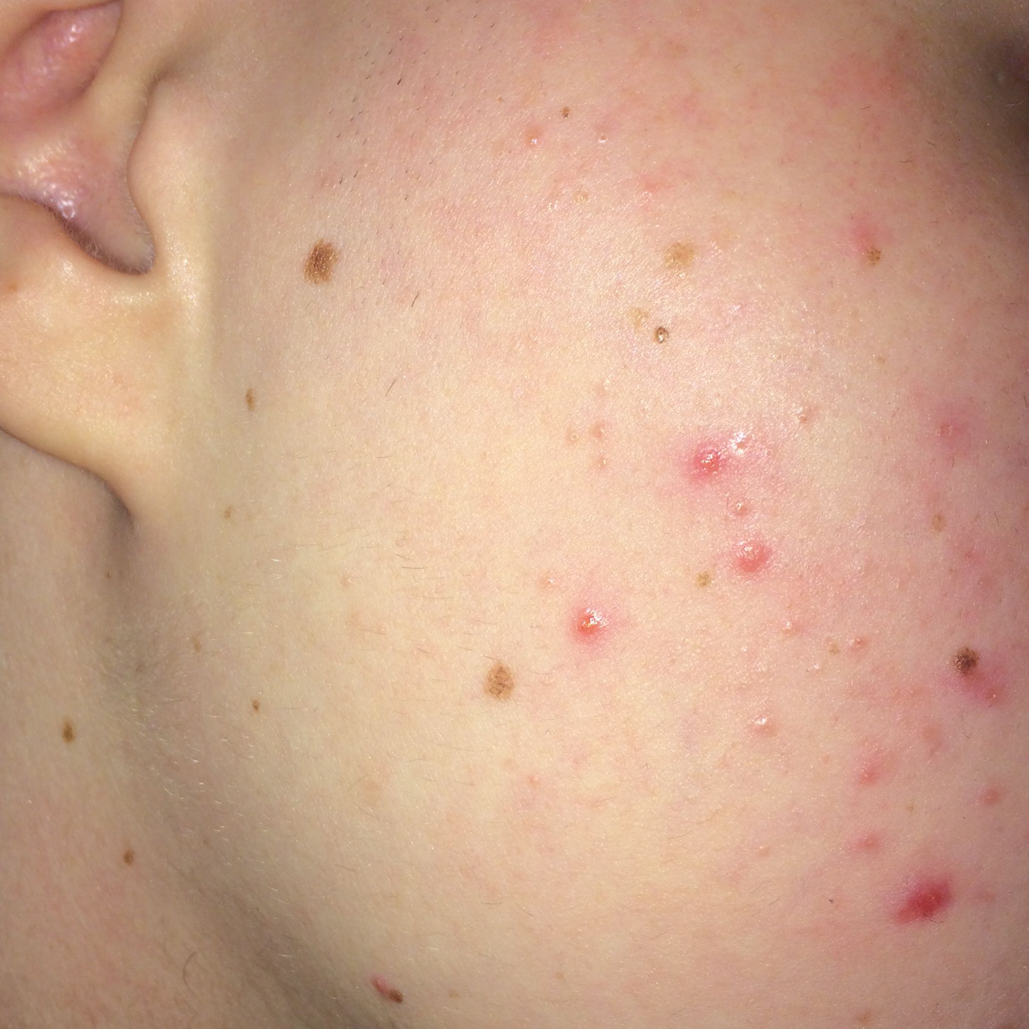 Plötzlich so viele Pickel, was tun? (Haut, Aussehen, Pflege) pickel an der wirbelsäule