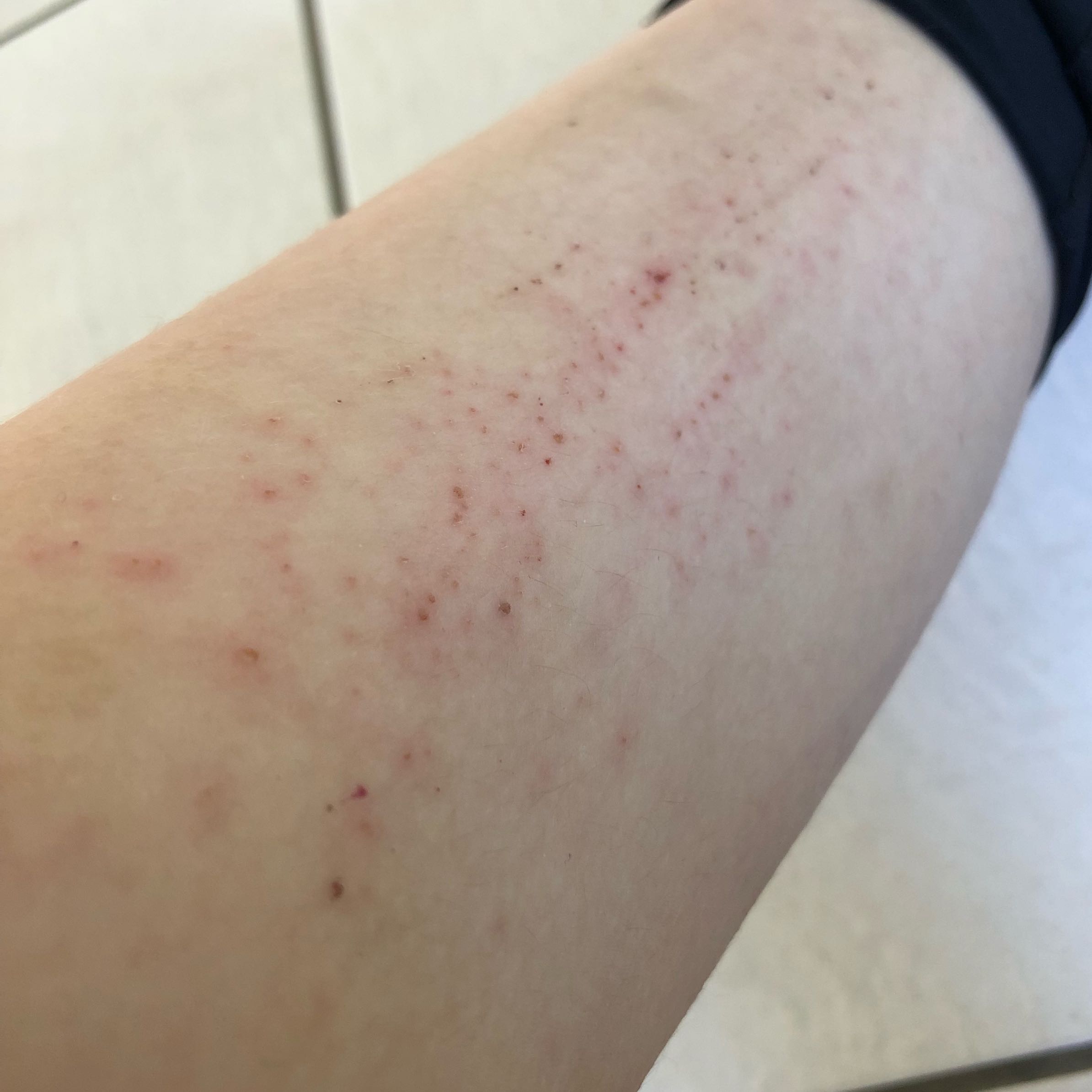 Plotzlich Starken Juckreiz An Den Beinen Gesundheit Und Medizin Haut Hautkrankheit Plotzlich Starken Juckreiz An Den Beinen Gesundheit Und Medizin Haut Hautkrankheit