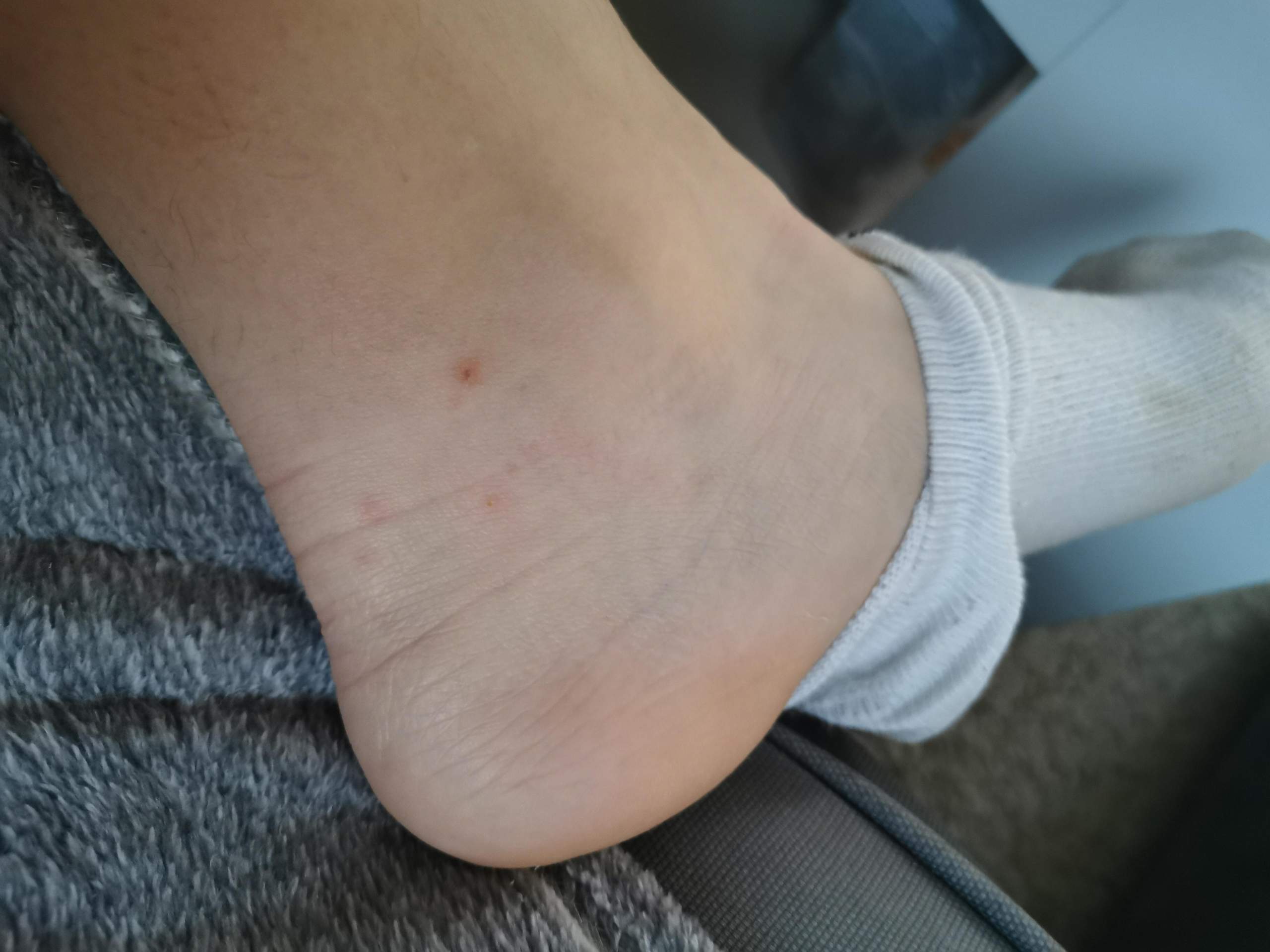 Plötzlich über Nacht Pickel an Beinen? (Gesundheit, Tiere, Haut)