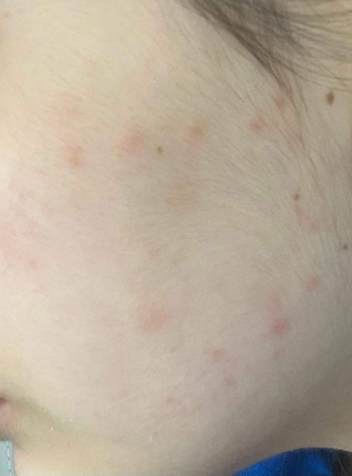 Plötzlich viele Pickel auf der Wange? (Gesundheit und Medizin, Haut, Gesicht) pickel auf der wange loswerden