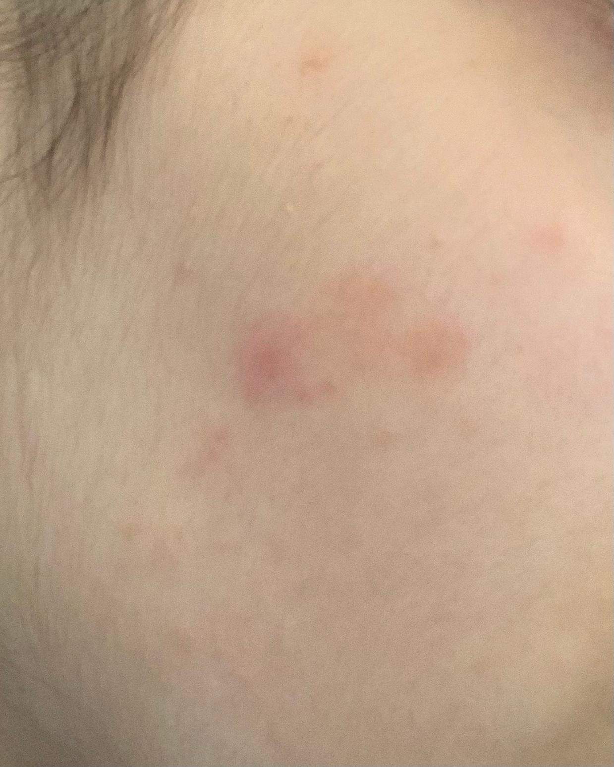 Plötzlich viele Pickel auf der Wange? (Gesundheit und Medizin, Haut, Gesicht) pickel auf der wange loswerden