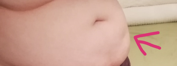 Plotzliche Kleine Delle Im Bauch Medizin Plotzliche Kleine Delle Im Bauch Medizin