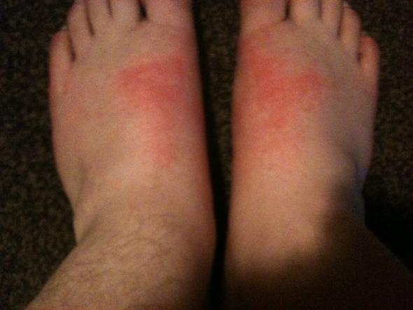 Plotzliche Rotung Und Schmerzen Am Fuss Gesundheit Korper Plotzliche Rotung Und Schmerzen Am Fuss Gesundheit Korper