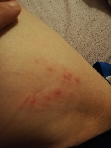 Plotzlicher Ausschlag Was Kann Das Sein Gesundheit Und Medizin Juckreiz Plotzlicher Ausschlag Was Kann Das Sein Gesundheit Und Medizin Juckreiz