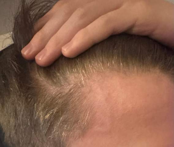 Plötzlicher Haarausfall M16? (Haare, Aussehen, Haarpflege)