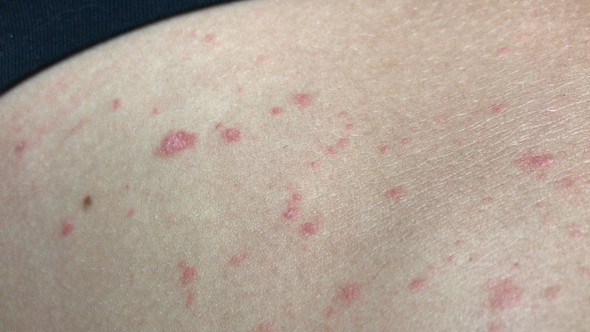 Plotzlicher Hautausschlag Hiv Gesundheit Und Medizin Haut Plotzlicher Hautausschlag Hiv Gesundheit Und Medizin Haut
