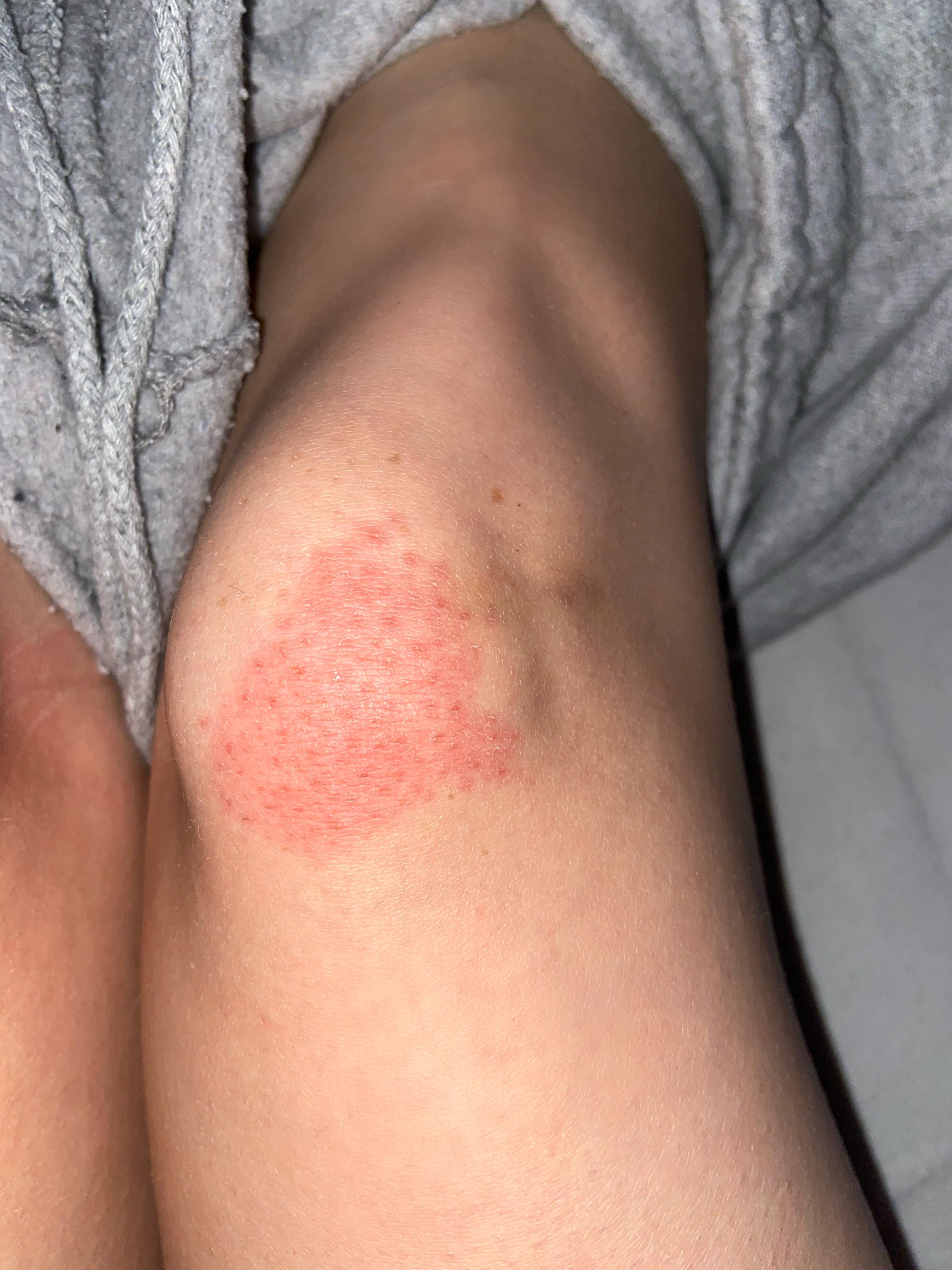 Plotzlicher Roter Fleck Am Knie Gesundheit Und Medizin Gesundheit Flecken Plotzlicher Roter Fleck Am Knie Gesundheit Und Medizin Gesundheit Flecken