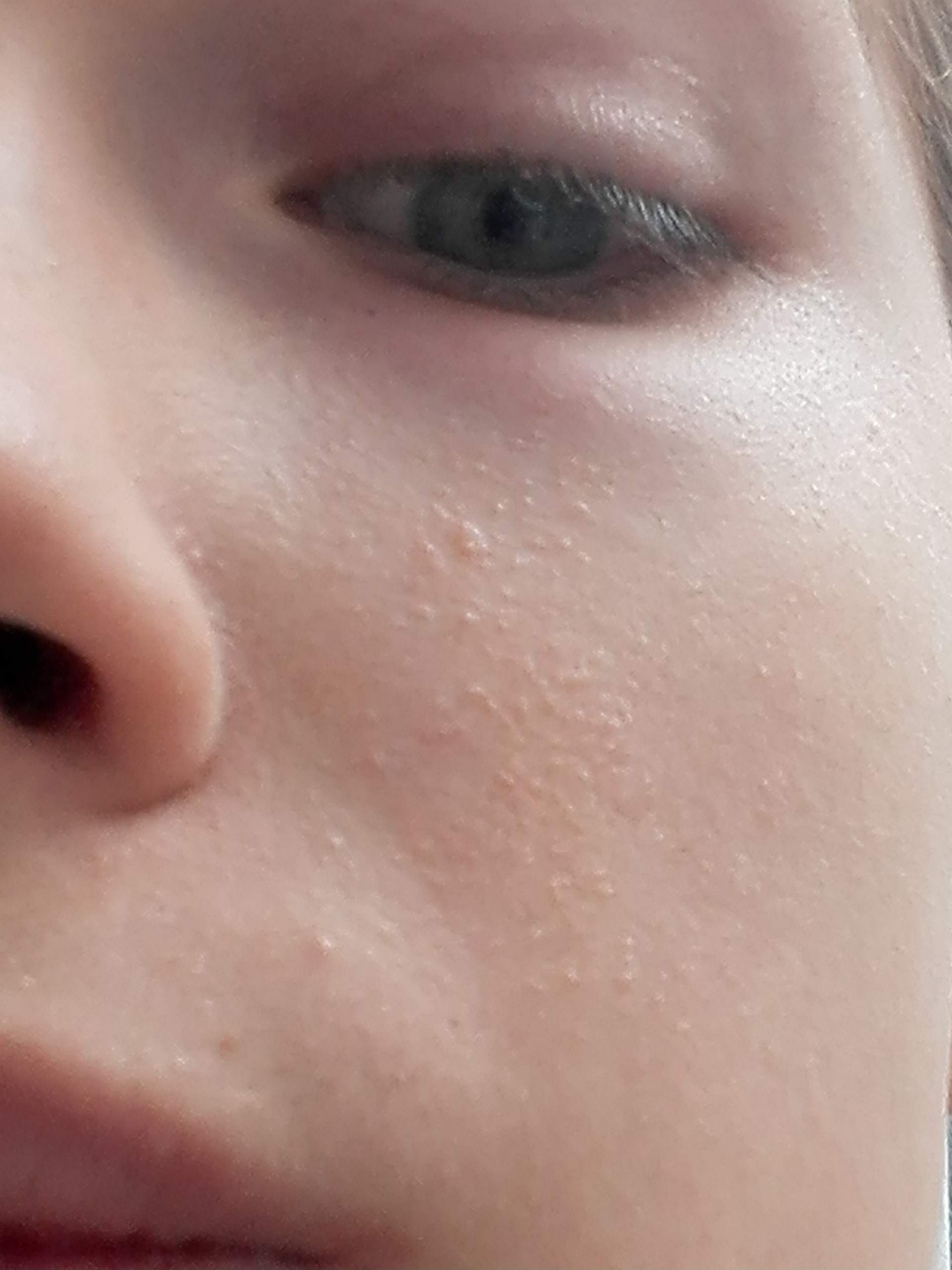 Plotzlichich Massig Kleine Pickel Im Gesicht Haut Ausschlag Plotzlichich Massig Kleine Pickel Im Gesicht Haut Ausschlag