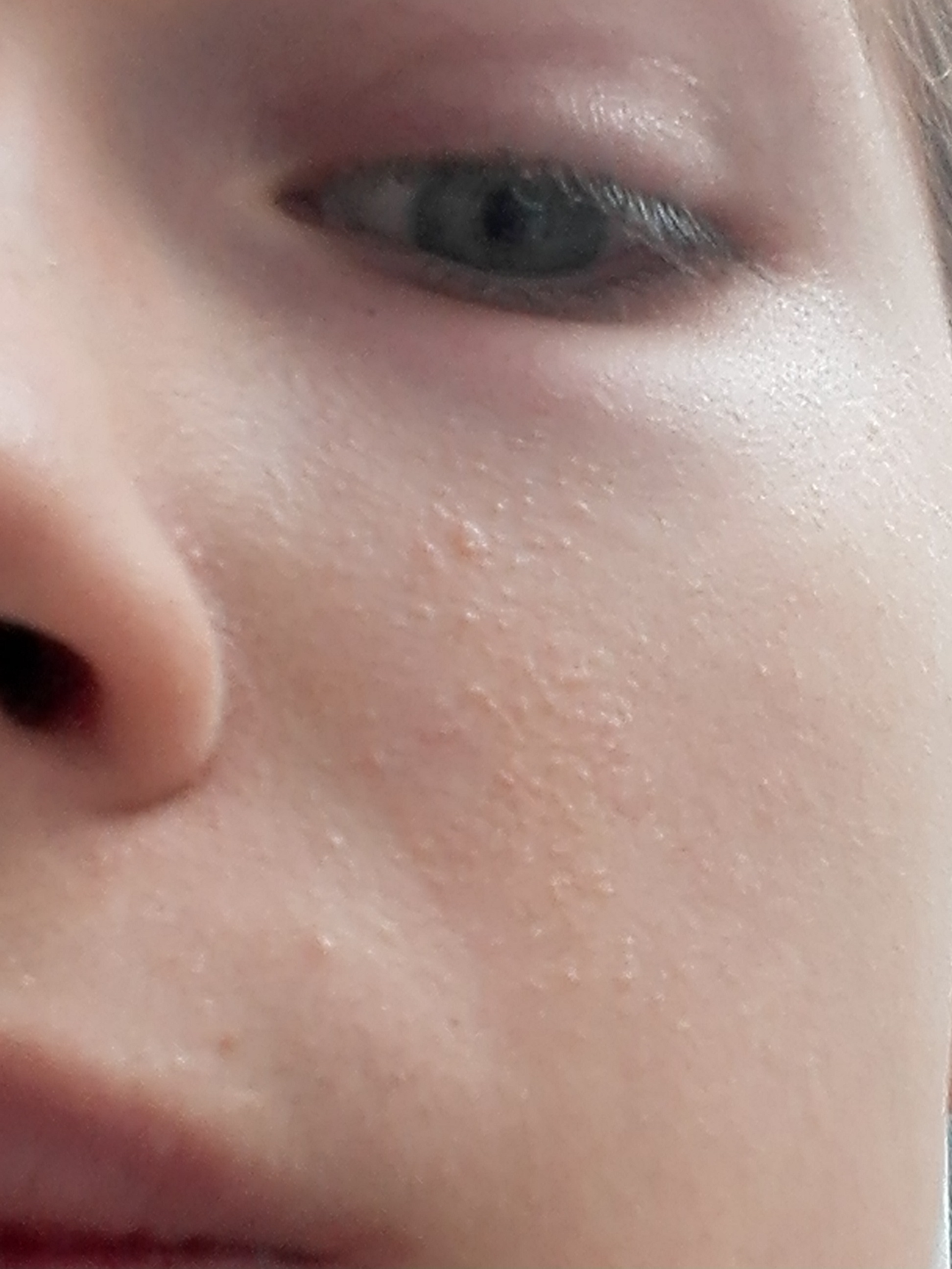 PlötzlichIch massig kleine Pickel im Gesicht? (Haut, Ausschlag) pickel im gesicht