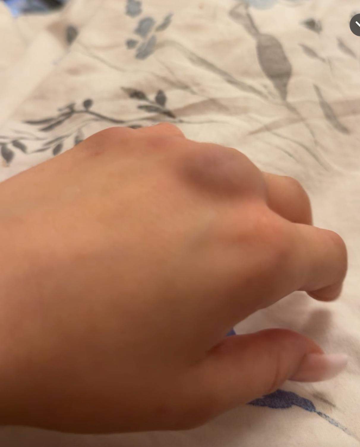 Prellung oder doch Bruch? (Schmerzen, Finger, Schwellung)