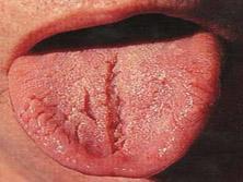 Problem Mit Zunge Hilfe Hasslich Eklig Risse Problem Mit Zunge Hilfe Hasslich Eklig Risse