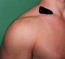 schwellung schwarz markiert - (Medizin, Körper, Muskeln)