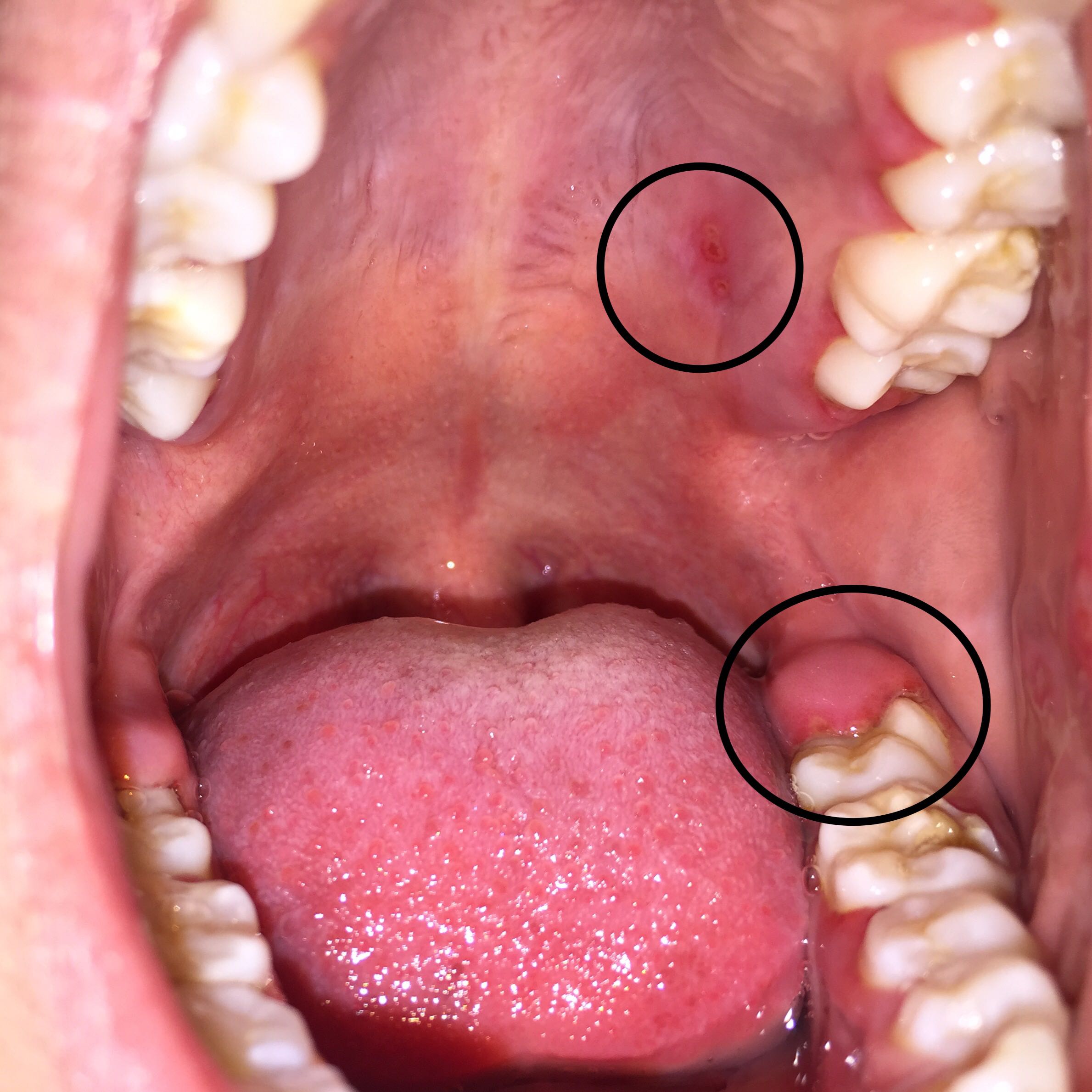 35++ Mund und rachenkrebs bilder , Probleme im Mund und Halsschmerzen, Zahnschmerzen , hilfe? (Zahnfleisch