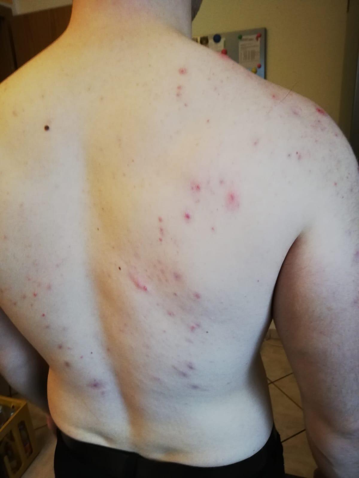 Probleme Mit Pickel Im Rucken Und Schulterbereich Hautprobleme Probleme Mit Pickel Im Rucken Und Schulterbereich Hautprobleme