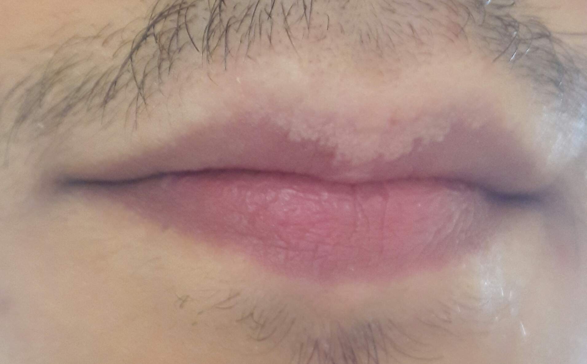 Pünktchen auf der Lippe. Normal? (Gesundheit, Arzt, Krankheit)