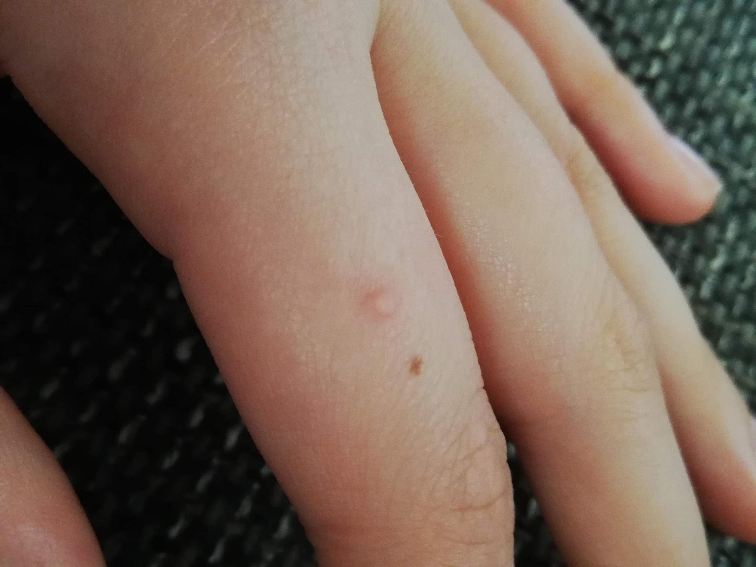 Punkt auf meiner Hand? (Gesundheit und Medizin, Gesundheit, Pickel) Punkt auf meiner Hand? (Gesundheit und Medizin, Gesundheit, Pickel)