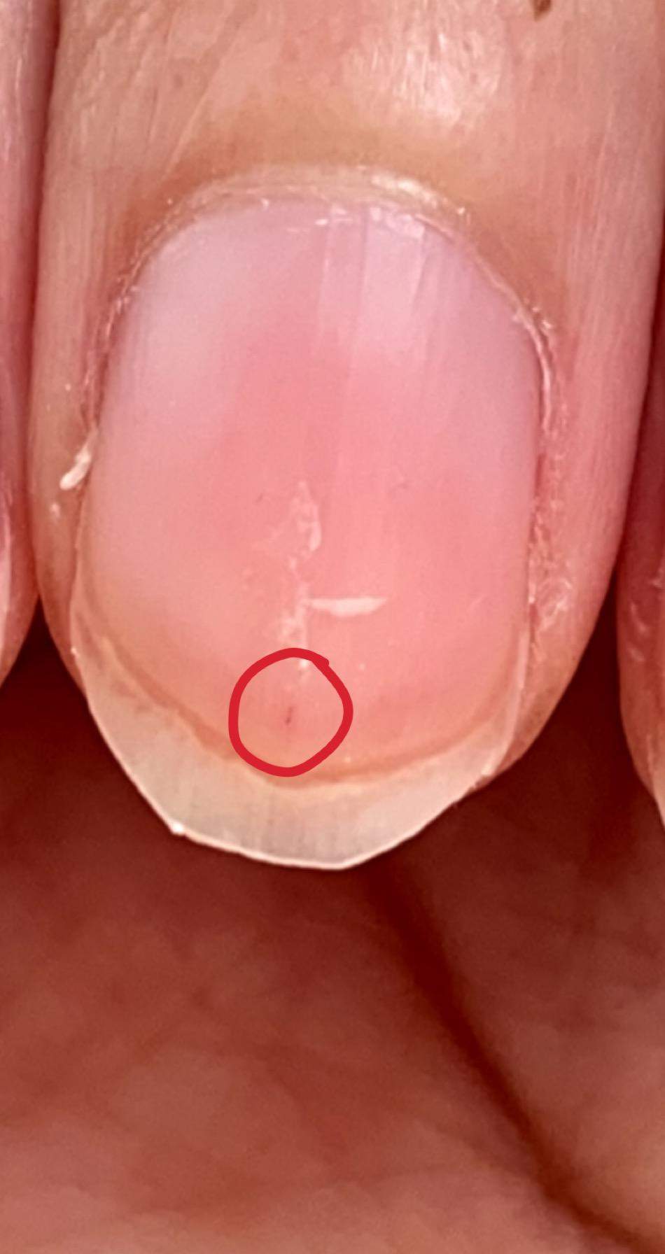 Punkte unter dem nagel? (Gesundheit und Medizin, Nägel)