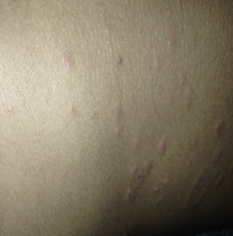 Punkte Pickel Auf Dem Bauch Punkte Pickel Auf Dem Bauch