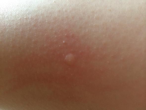 Quaddel Am Bein Gesundheit Korper Haut Quaddel Am Bein Gesundheit Korper Haut