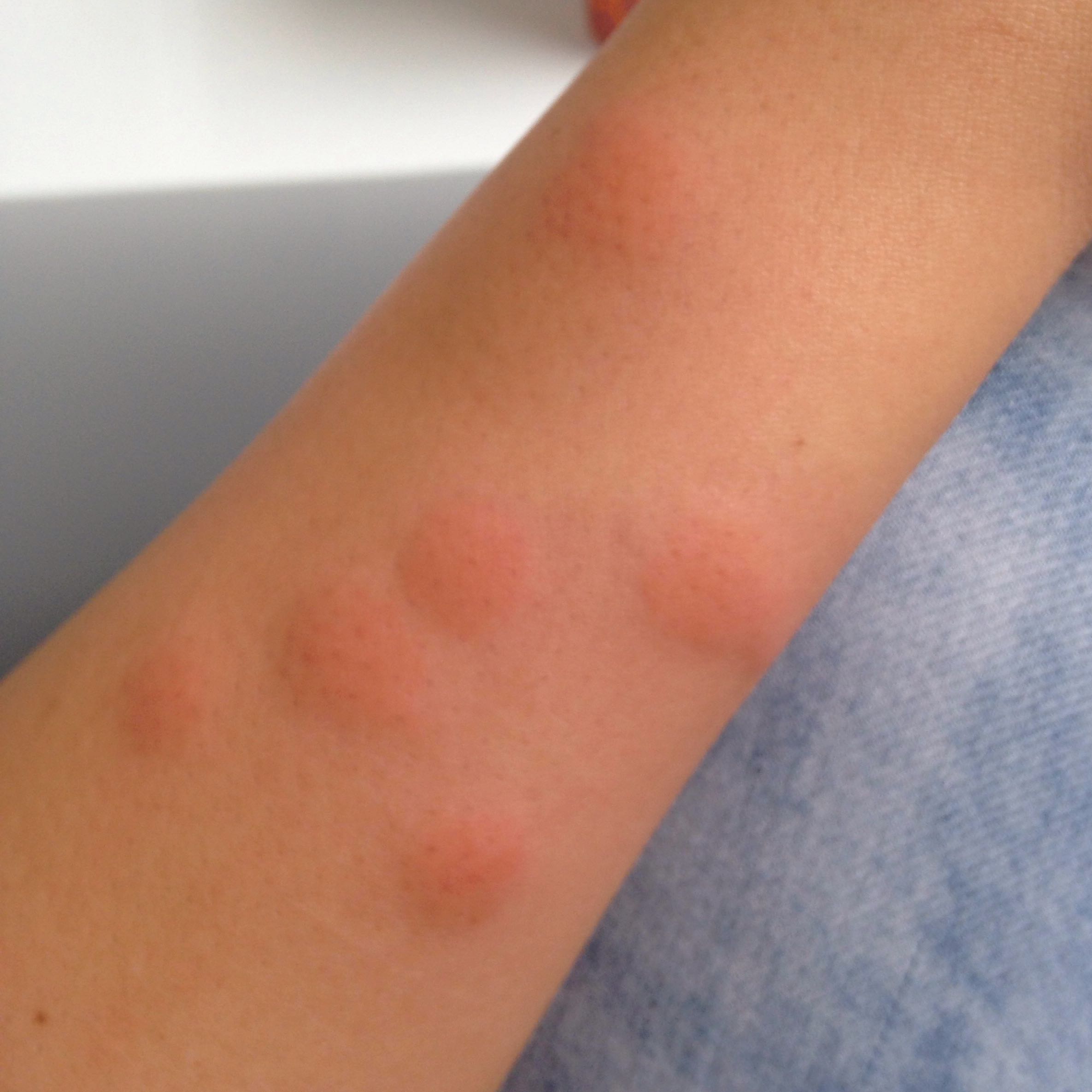 Quaddeln am Arm? (Gesundheit, Haut, Ausschlag)