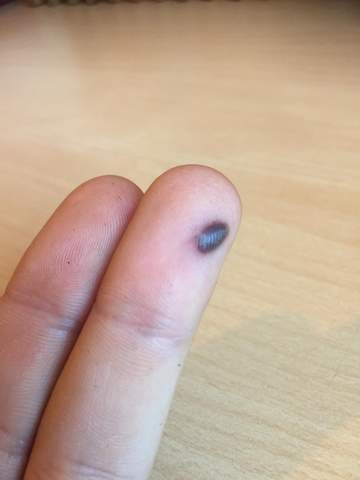 Quetschung Am Finger Was Tun Medizin Unfall Hand Quetschung Am Finger Was Tun Medizin Unfall Hand