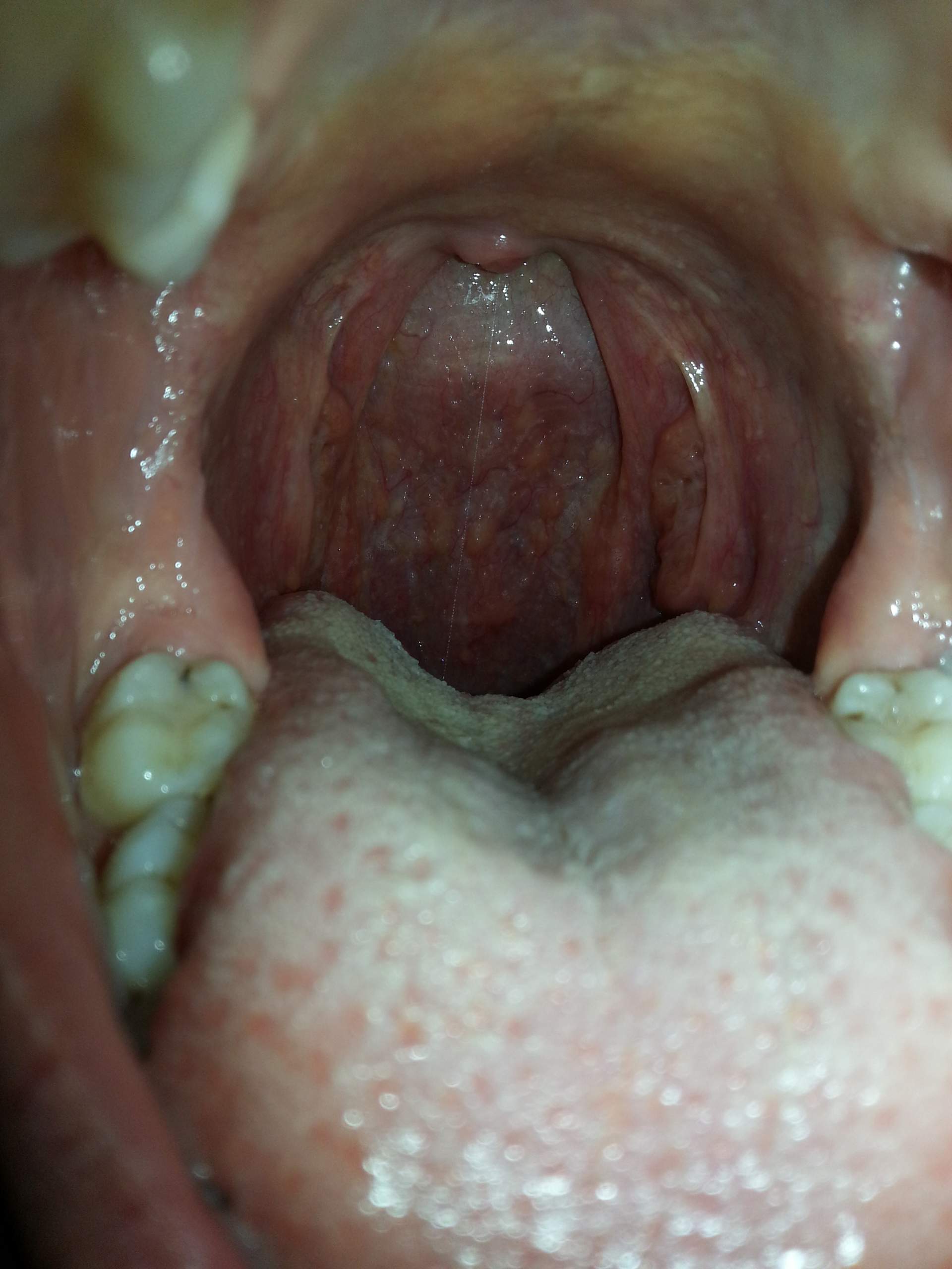Rachen entzündet, Diagnose? (Medizin, krank, Virus)
