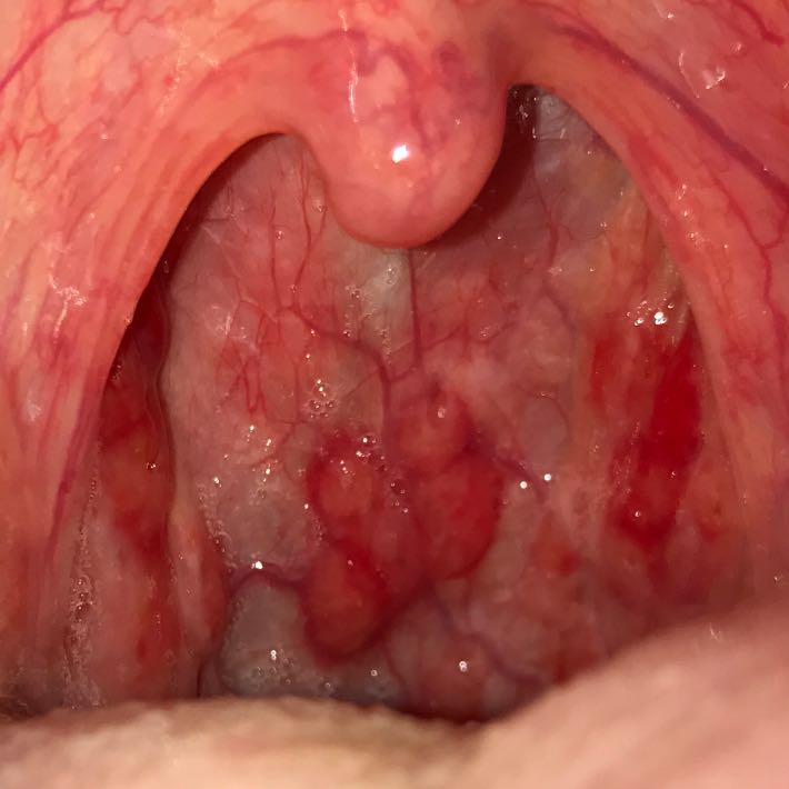36++ Mund und rachenkrebs bilder , Ist der Rachen normal entzündet? (Entzündung)